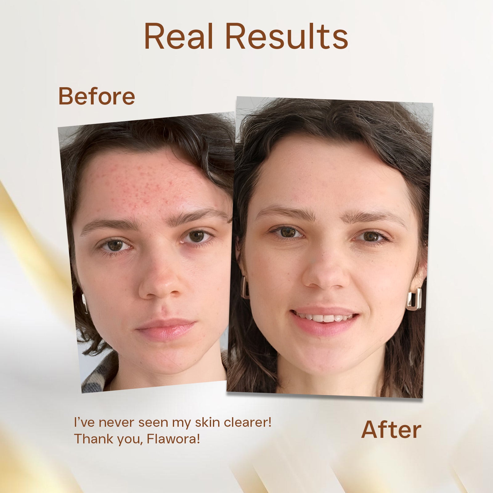 Anti Acne Serum Product Real Results Image